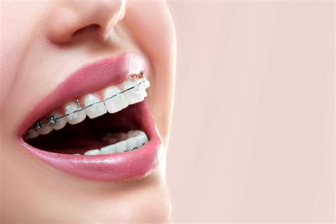 que diferencia hay entre los brackets metalicos y esteticos|Brackets estéticos vs metálicos: ¿Cuál es la mejor .